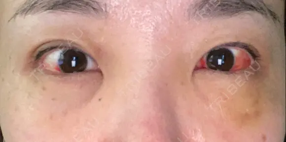 クマ治療 / 下まぶたの脂肪取り TCB東京中央美容外科 中野院 DAY 3 メイン用