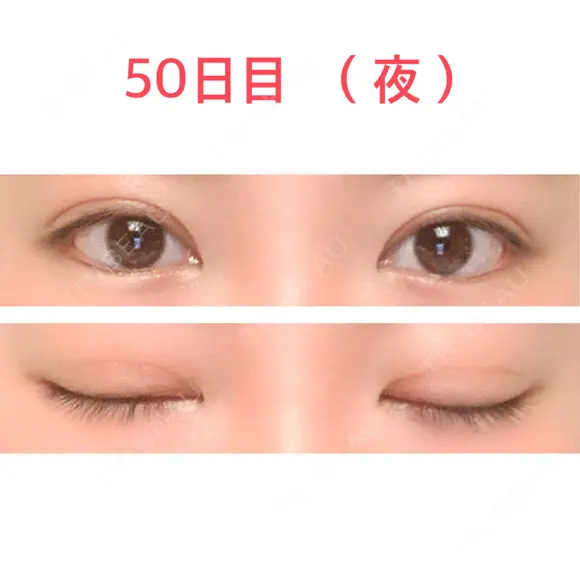 二重切開 水の森美容クリニック 東京新宿院 DAY 50 メイン用