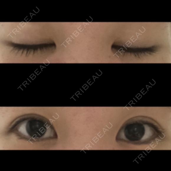 二重埋没 東京形成美容外科 船橋院 DAY 106 メイン用