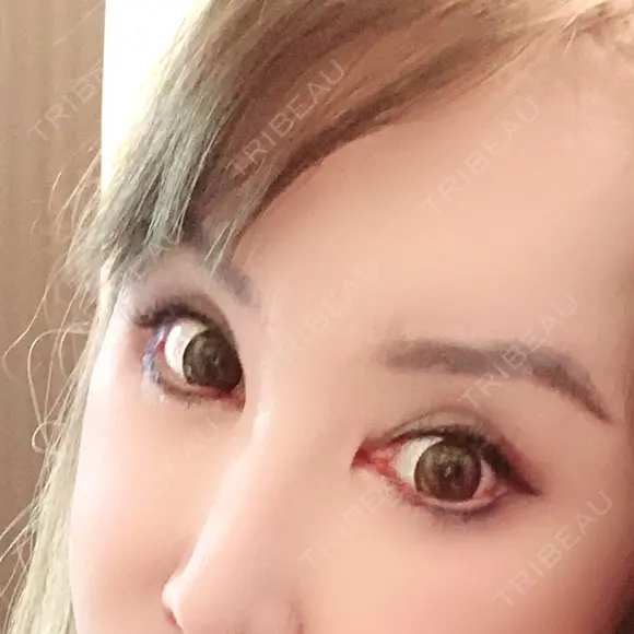 眼瞼下垂（切開） / クマ治療 / 目尻切開 / 下まぶたたるみ取り / 下まぶたの脂肪取り / タレ目形成・グラマラスライン（切開） / 眉下切開 id（アイディ）美容外科 AFTER メイン用