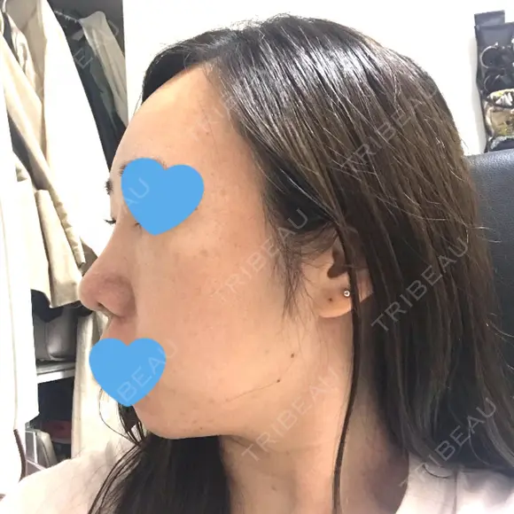 鼻尖形成（切開） / 軟骨移植 / 眉間プロテーゼ / 鼻尖縮小 湘南美容クリニック 柏院 DAY 43 メイン用