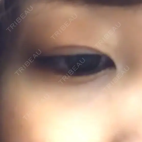 二重埋没 高須クリニック 名古屋院 DAY 55 メイン用