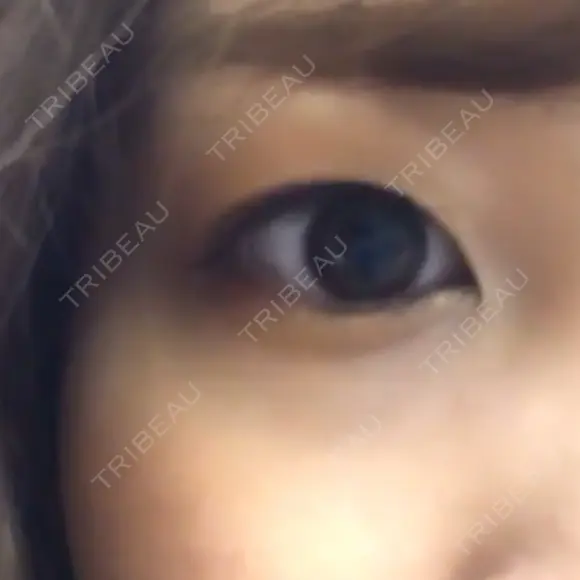 二重埋没 高須クリニック 名古屋院 DAY 55 メイン用