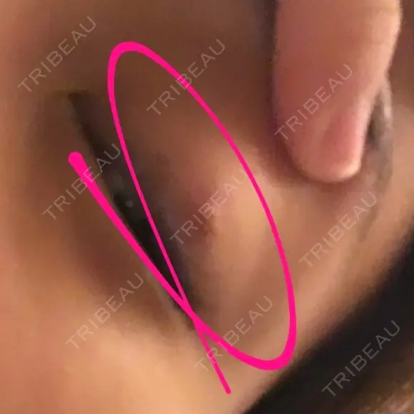 二重埋没 高須クリニック 名古屋院 DAY 62 メイン用