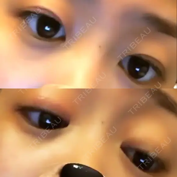 二重埋没 高須クリニック 名古屋院 DAY 92 メイン用