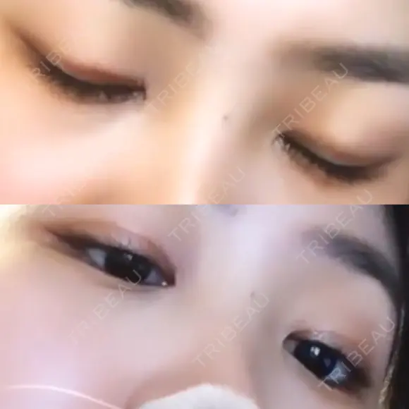 二重埋没 高須クリニック 名古屋院 DAY 245 メイン用