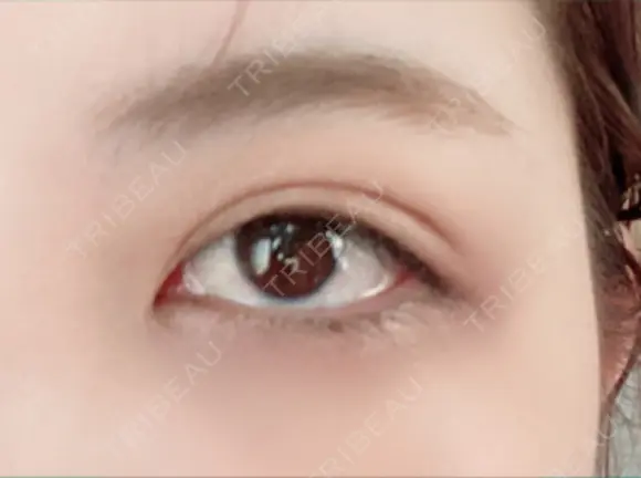 二重埋没 湘南美容クリニック 藤沢院 DAY 6 メイン用