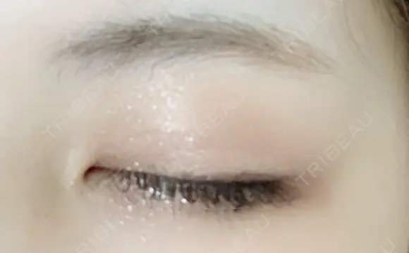 二重埋没 湘南美容クリニック 藤沢院 DAY 7 メイン用