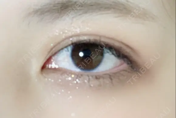 二重埋没 湘南美容クリニック 藤沢院 DAY 7 メイン用