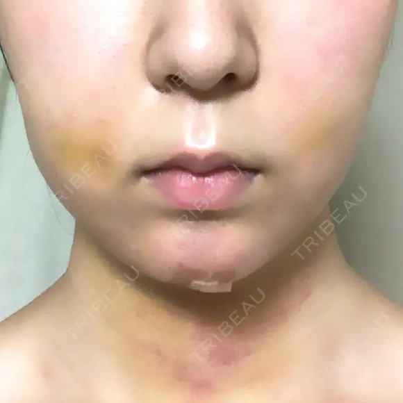 脂肪吸引（顔） / メーラーファット除去 / ボトックス（あご） WOM CLINIC GINZA （ワム クリニック ギンザ） DAY 5 メイン用