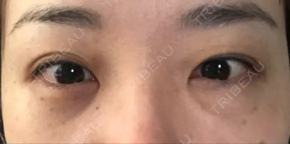 クマ治療 / 下まぶたの脂肪取り TCB東京中央美容外科 中野院 AFTER メイン用