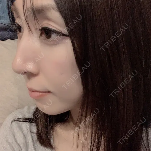 骨切り（あご） / 骨削り（エラ） / 骨削り（頬） / 脂肪注入（輪郭） バノバギ整形外科 DAY 213 メイン用
