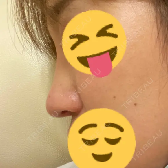 二重切開 / 目頭切開 / 鼻尖形成（切開） / 鼻中隔延長（切開） / 小鼻縮小（切開） / タレ目形成・グラマラスライン（切開） / 鼻尖縮小 / 鼻翼基部形成（貴族手術） グローバルビューティークリニック 大阪院 DAY 170 メイン用