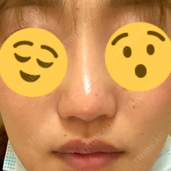 二重切開 / 目頭切開 / 鼻尖形成（切開） / 鼻中隔延長（切開） / 小鼻縮小（切開） / タレ目形成・グラマラスライン（切開） / 鼻尖縮小 / 鼻翼基部形成（貴族手術） グローバルビューティークリニック 大阪院 DAY 170 メイン用