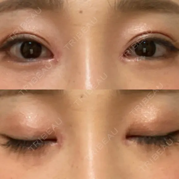 二重切開 / 目頭切開 / 鼻尖形成（切開） / 鼻中隔延長（切開） / 小鼻縮小（切開） / タレ目形成・グラマラスライン（切開） / 鼻尖縮小 / 鼻翼基部形成（貴族手術） グローバルビューティークリニック 大阪院 AFTER メイン用