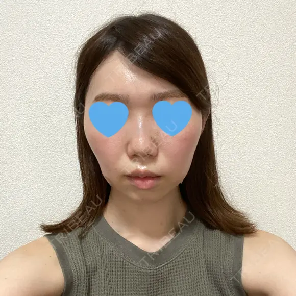 脂肪溶解注射（顔） 赤坂プレミアクリニック DAY 0 メイン用