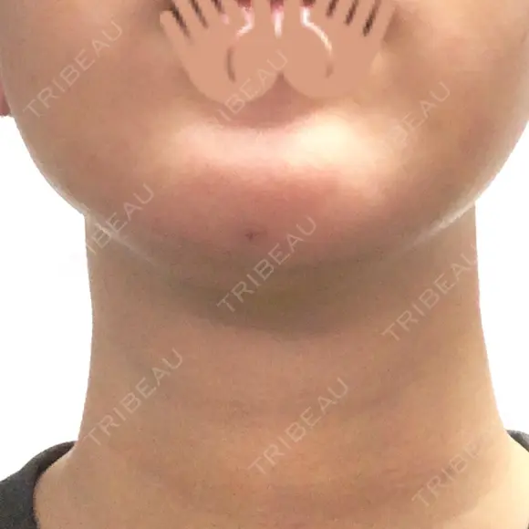 脂肪吸引（顔） / メーラーファット除去 / ボトックス（あご） WOM CLINIC GINZA （ワム クリニック ギンザ） DAY 8 メイン用