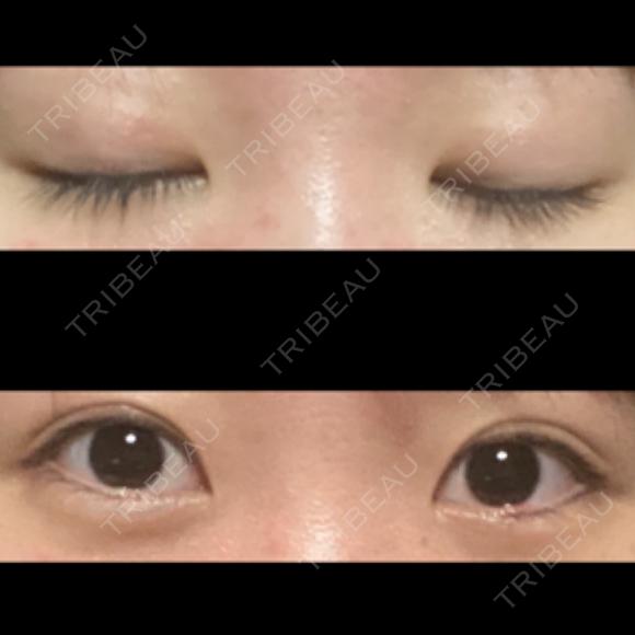 二重埋没 東京形成美容外科 船橋院 DAY 112 メイン用