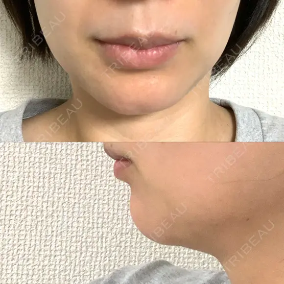 ボトックス（あご） PICO BEAUTY CLINIC DAY 4 メイン用