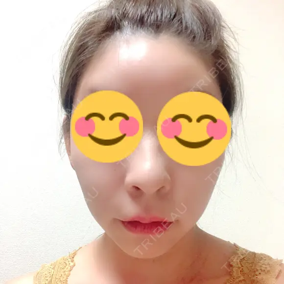 骨切り（あご） / 骨削り（頬） / ガミースマイル手術 / ルフォー+ssro（両あご) ウォンジン（Wonjin）整形外科 DAY 227 メイン用