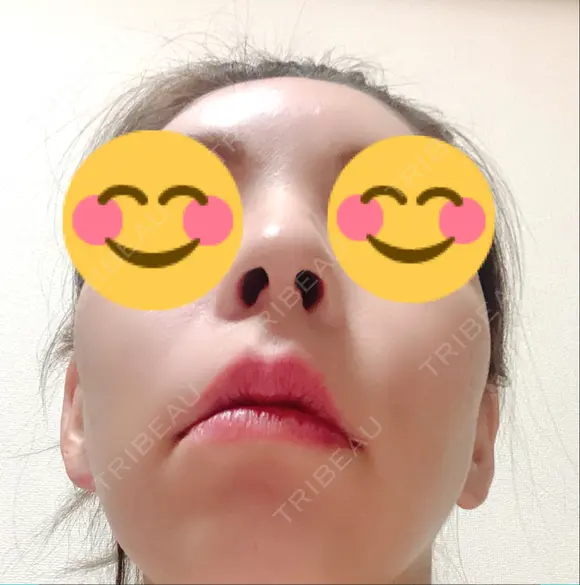 骨切り（あご） / 骨削り（頬） / ガミースマイル手術 / ルフォー+ssro（両あご) ウォンジン（Wonjin）整形外科 DAY 227 メイン用