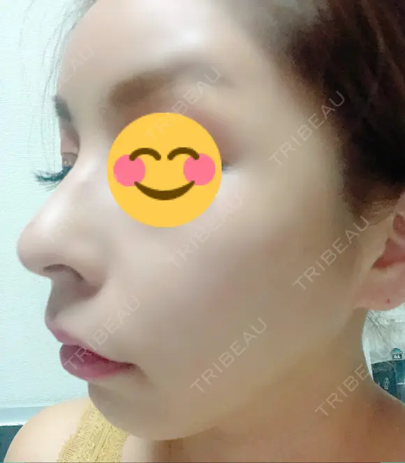 骨切り（あご） / 骨削り（頬） / ガミースマイル手術 / ルフォー+ssro（両あご) ウォンジン（Wonjin）整形外科 DAY 227 メイン用