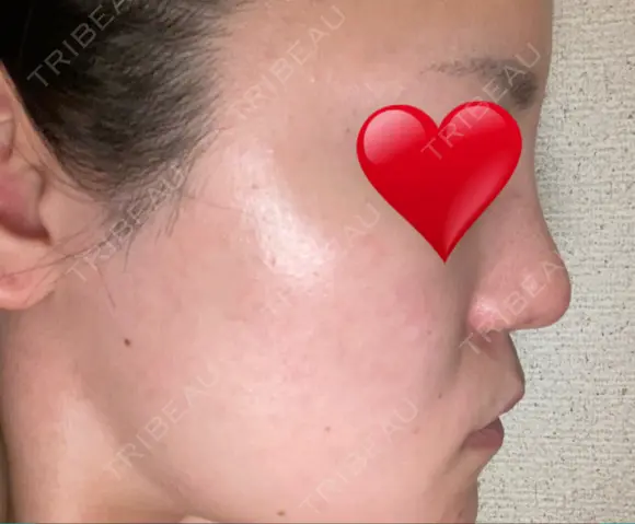 隆鼻術 / 鼻尖形成（切開） / 小鼻縮小（切開） / 軟骨移植 / 鼻翼基部形成（貴族手術） グローバルビューティークリニック 大阪院 DAY 29 メイン用