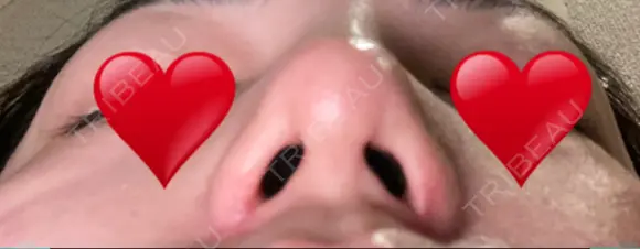 隆鼻術 / 鼻尖形成（切開） / 小鼻縮小（切開） / 軟骨移植 / 鼻翼基部形成（貴族手術） グローバルビューティークリニック 大阪院 DAY 29 メイン用