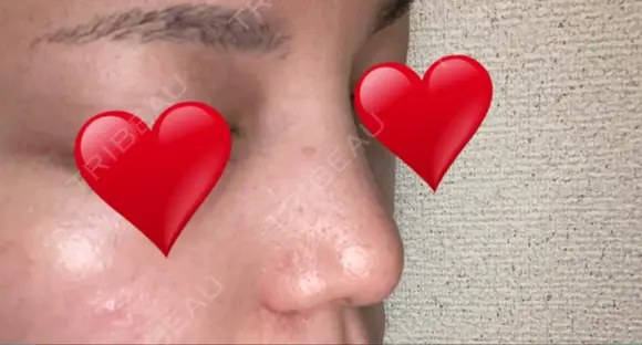 隆鼻術 / 鼻尖形成（切開） / 小鼻縮小（切開） / 軟骨移植 / 鼻翼基部形成（貴族手術） グローバルビューティークリニック 大阪院 DAY 29 メイン用