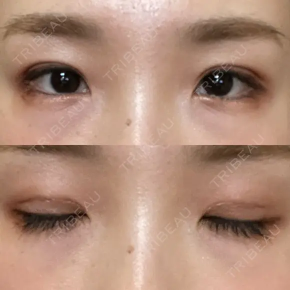 二重埋没 湘南美容クリニック 赤坂見附院 DAY 14 メイン用