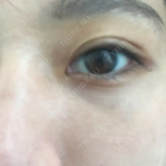 下まぶたたるみ取り セオリークリニック DAY 32 メイン用