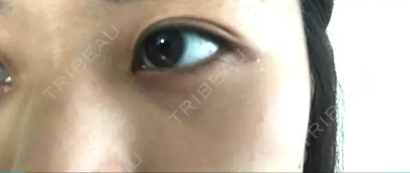 下まぶたたるみ取り セオリークリニック DAY 61 メイン用