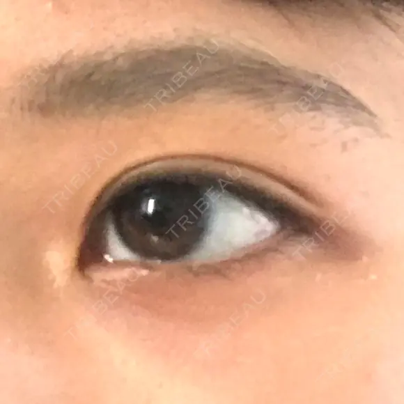 下まぶたたるみ取り セオリークリニック AFTER メイン用