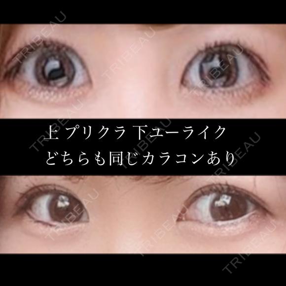 二重埋没 東京形成美容外科 船橋院 DAY 113 メイン用
