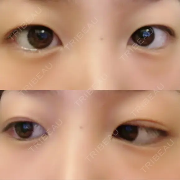 二重埋没 高須クリニック 名古屋院 AFTER メイン用