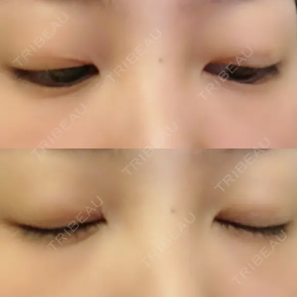 二重埋没 高須クリニック 名古屋院 DAY 366 メイン用