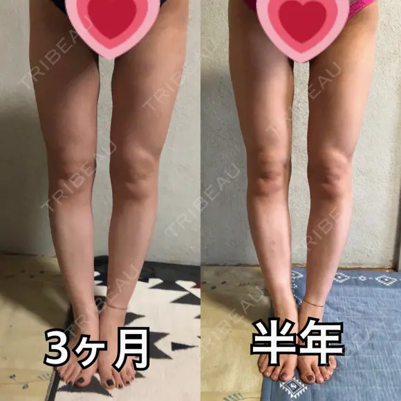 脂肪吸引（脚） / 豊胸（脂肪注入） 水の森美容クリニック 東京新宿院 DAY 180 メイン用