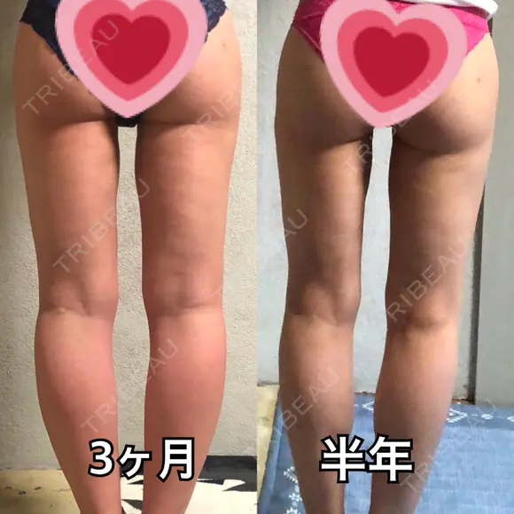 脂肪吸引（脚） / 豊胸（脂肪注入） 水の森美容クリニック 東京新宿院 DAY 180 メイン用