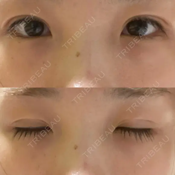 二重埋没 湘南美容クリニック 赤坂見附院 DAY 15 メイン用