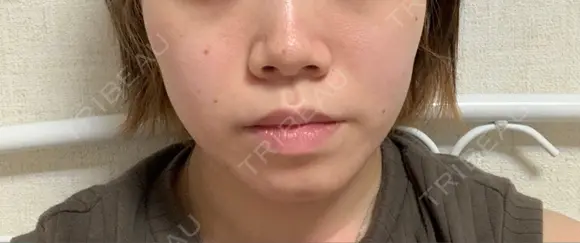 ボトックス（エラ・小顔） 湘南美容クリニック 川崎院 DAY 0 メイン用