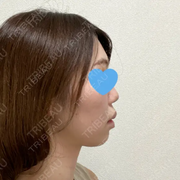 脂肪溶解注射（顔） 赤坂プレミアクリニック DAY 5 メイン用