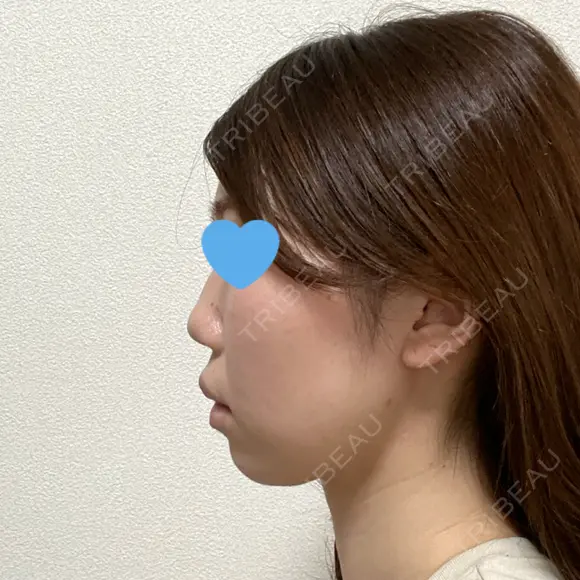 脂肪溶解注射（顔） 赤坂プレミアクリニック DAY 5 メイン用