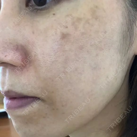 シミ取りレーザー / YAGレーザー 仁愛クリニック DAY 78 メイン用