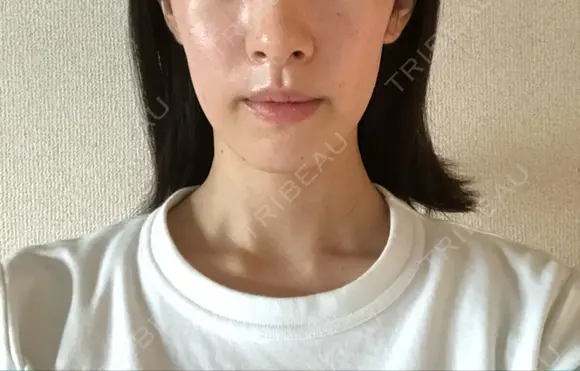 脂肪溶解注射（顔） 銀座フェイスクリニック（小顔整形・輪郭整形專門） DAY 7 メイン用
