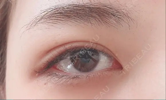 二重埋没 湘南美容クリニック 藤沢院 DAY 15 メイン用