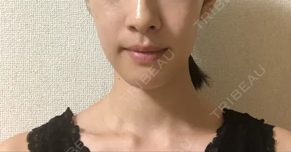 脂肪溶解注射（顔） 銀座フェイスクリニック（小顔整形・輪郭整形專門） DAY 8 メイン用