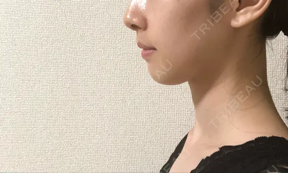 脂肪溶解注射（顔） 銀座フェイスクリニック（小顔整形・輪郭整形專門） DAY 8 メイン用