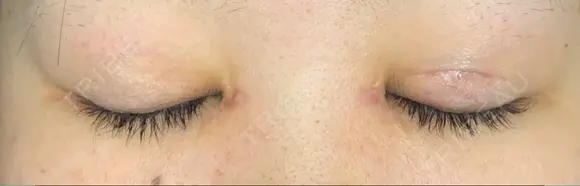 二重切開 / 目頭切開 / 上まぶたたるみ取り / 上まぶたの脂肪取り 湘南美容クリニック 広島院 DAY 79 メイン用