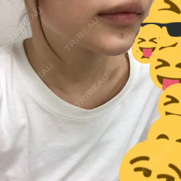 ヒアルロン酸注入（あご） / その他（輪郭） 東京形成美容外科 船橋院 DAY 0 メイン用