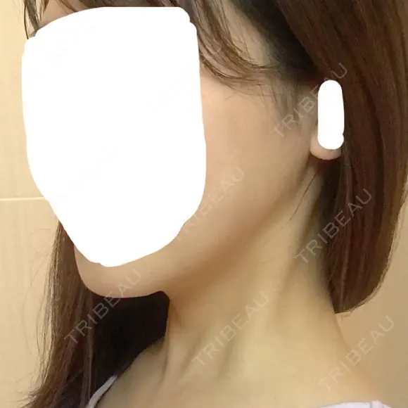 糸リフト / 脂肪吸引（顔） / その他（輪郭） / 切開リフト 清潭清楚整形外科 DAY 31 メイン用